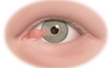 Pterygium Surgery