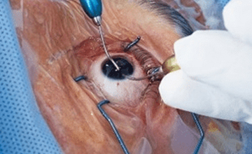 Cataract Surgery