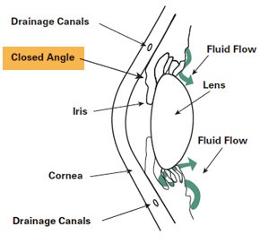 >Open-angle glaucoma 
